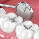 amalgam-dolgular-degistirilmeli-mi.jpg
